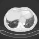 Lung fibrosis, basal: CT - Computed tomography